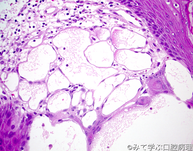 管 腫 リンパ 血管腫、血管奇形・リンパ管奇形（リンパ管腫）